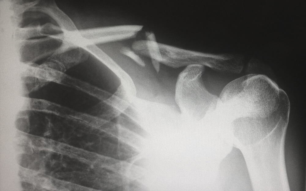 X-ray of broken bone
